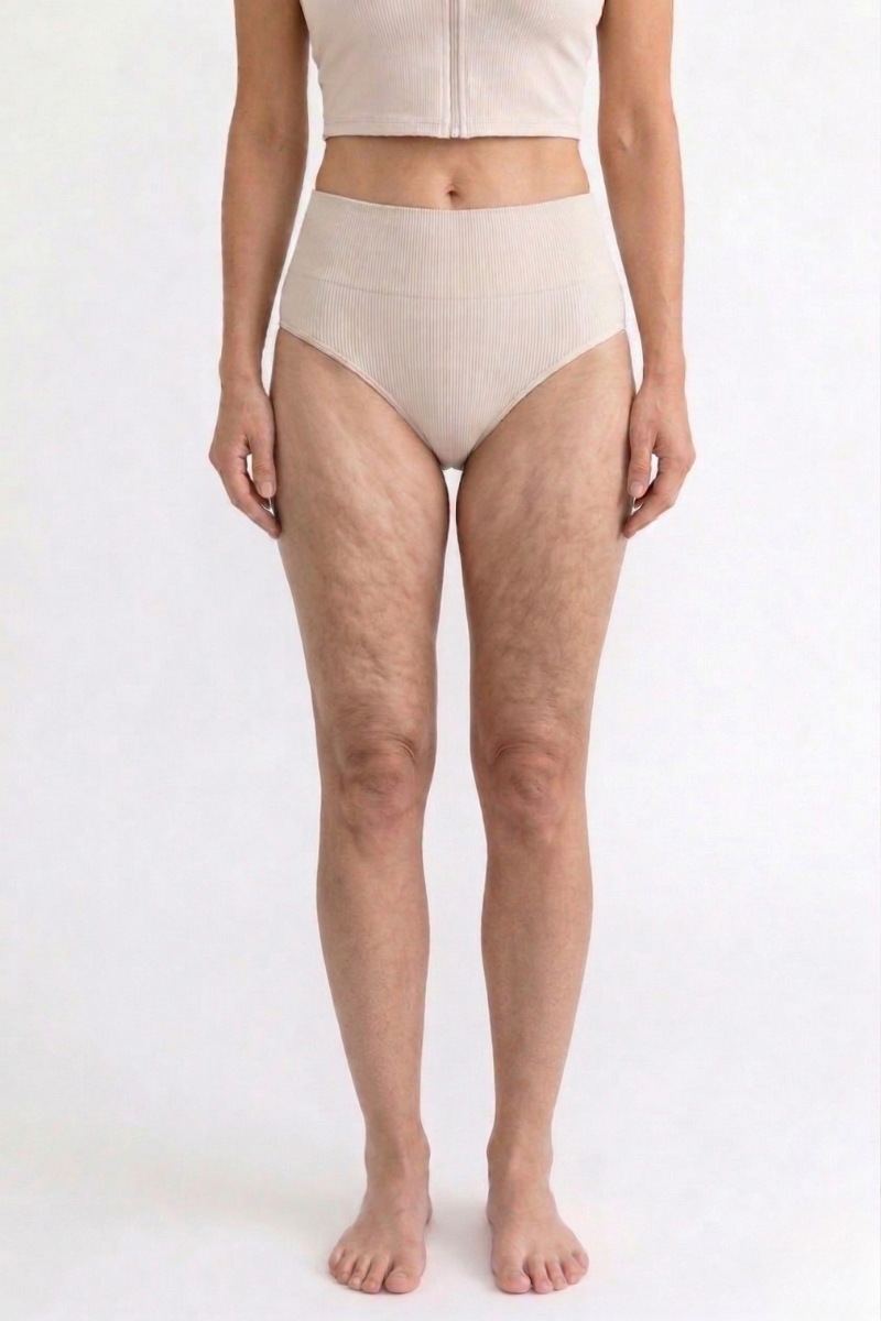 Woman with visible cellulite on thighs — before wearing anti-cellulite leggings by Kalt